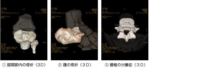 MDCT写真　膝関節内の骨折　踵の骨折　腰椎の分離症