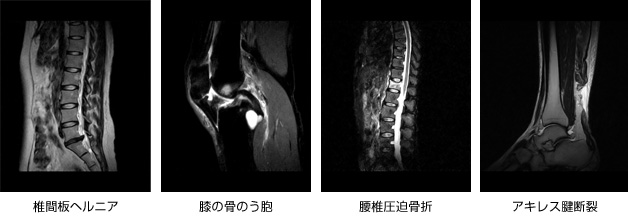 MRI写真　椎間板ヘルニア　膝の骨のう胞　腰椎圧迫骨折　アキレス腱断裂